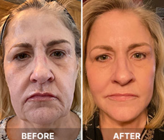 South Beach Collagen Filler Serum Benefits